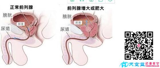经尿道前列腺等离子双极电切术动画视频d.jpg 经尿道前列腺等离子双极电切术动画视频d.jpg