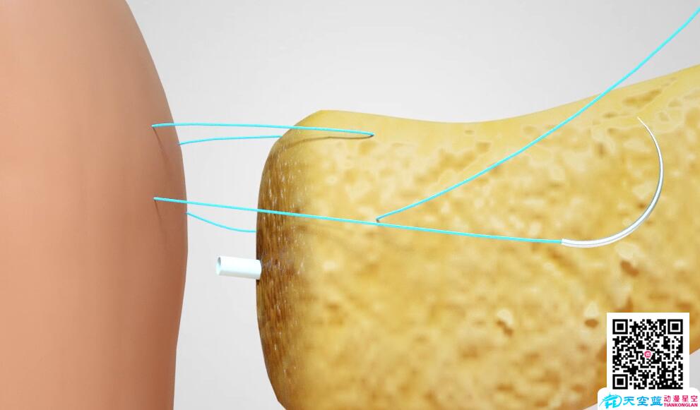 三维3d动画演示胰十二指肠切除术3.jpg