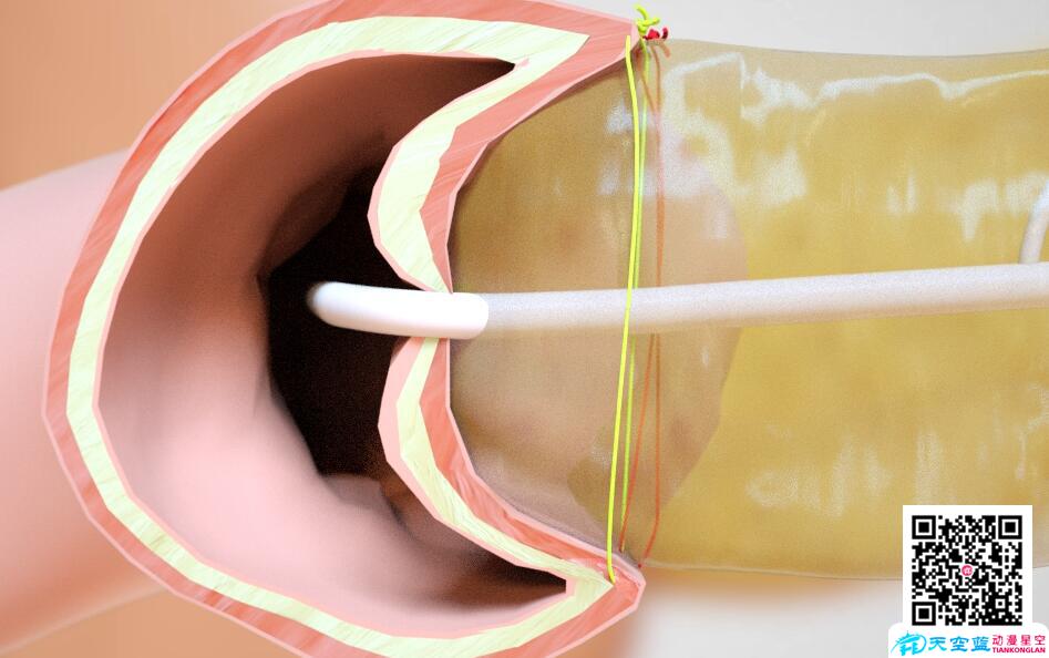 三维3d动画演示胰十二指肠切除术8.jpg