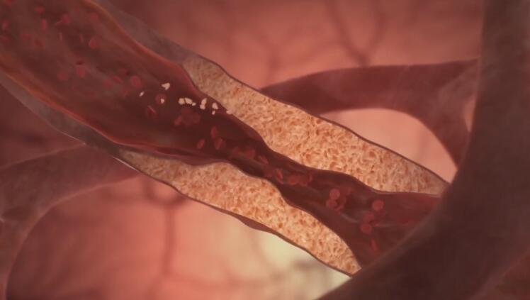 「动画制作」血管成形术医学演示3d动画制作2.jpg