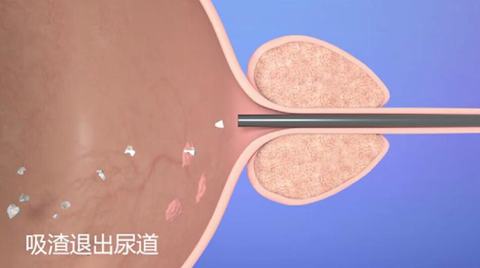 膀胱肿瘤的检查.jpg 膀胱肿瘤的检查.jpg