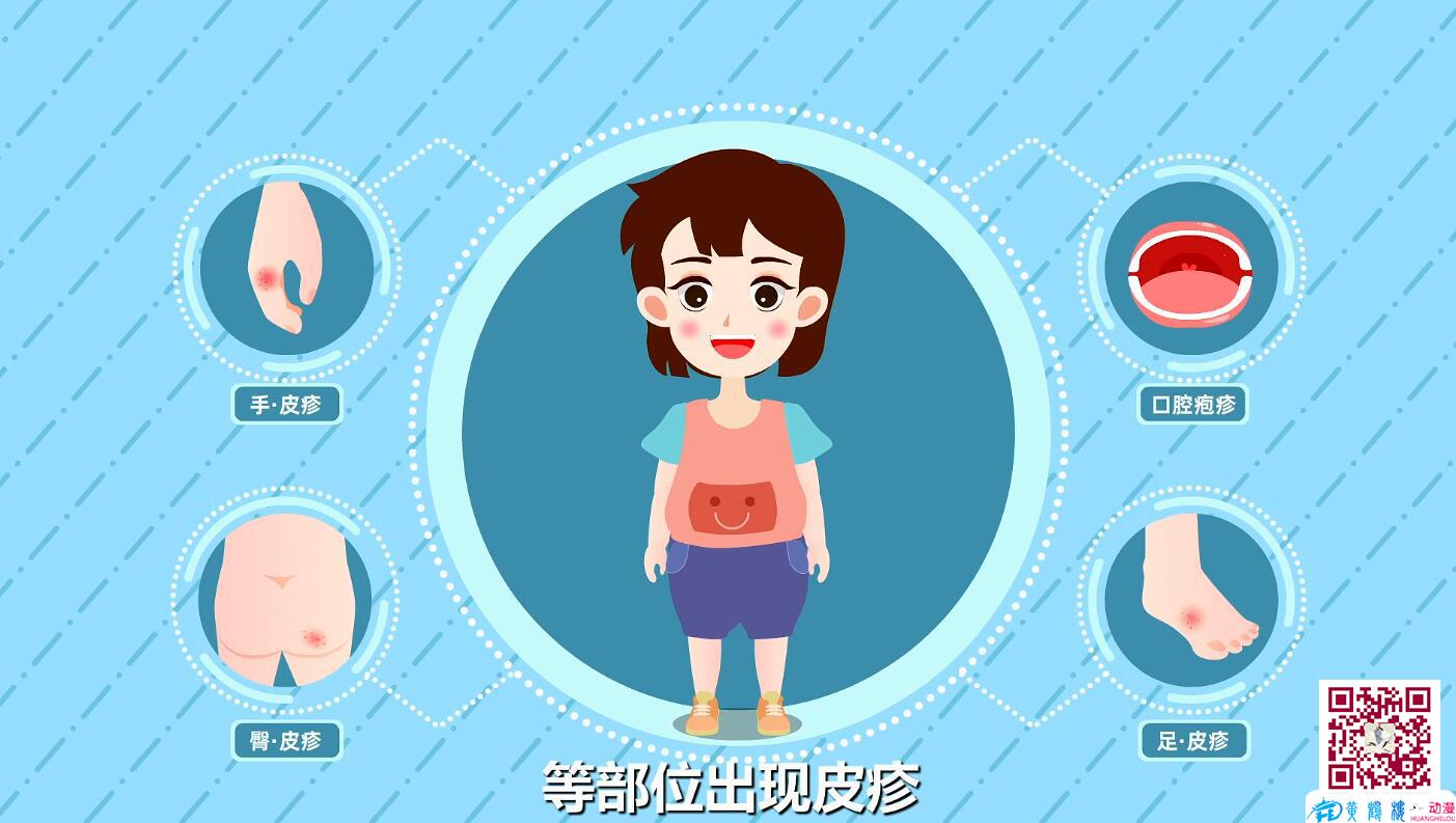 手足口病防治小知识早期症状身体.jpg 手足口病防治小知识早期症状身体.jpg