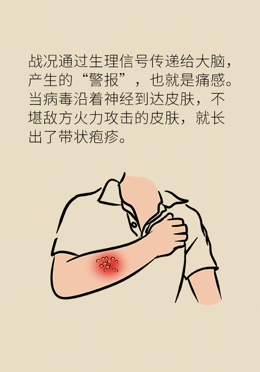带状孢疹病毒