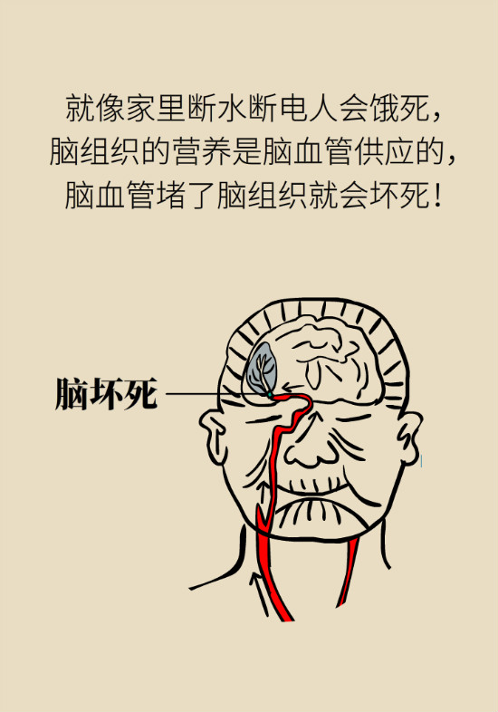 腔隙性脑梗死一定是脑血管堵了吗？