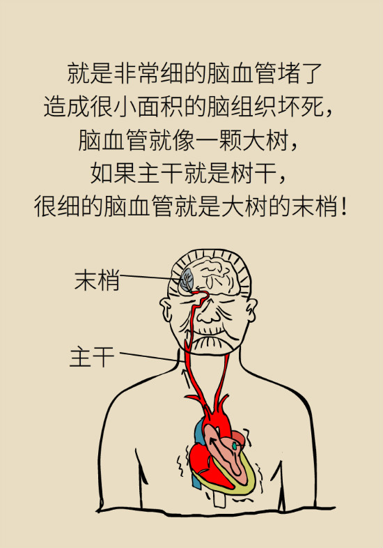 腔隙性脑梗死一定是脑血管堵了吗