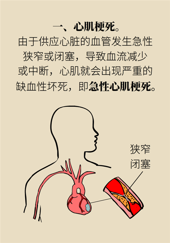 心绞痛科普动漫制作