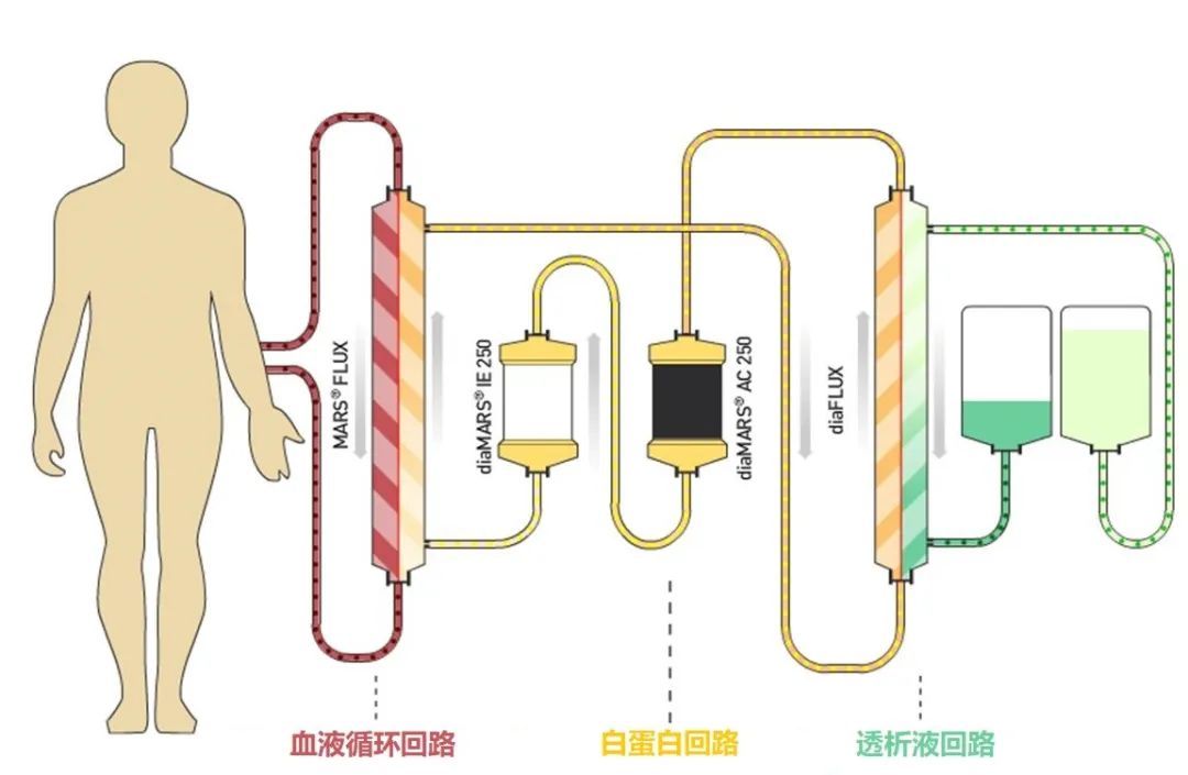 新冠病毒疫情中的救命神器“人工肝”,是怎样炼成的? 新冠病毒疫情中的救命神器“人工肝”,是怎样炼成的?