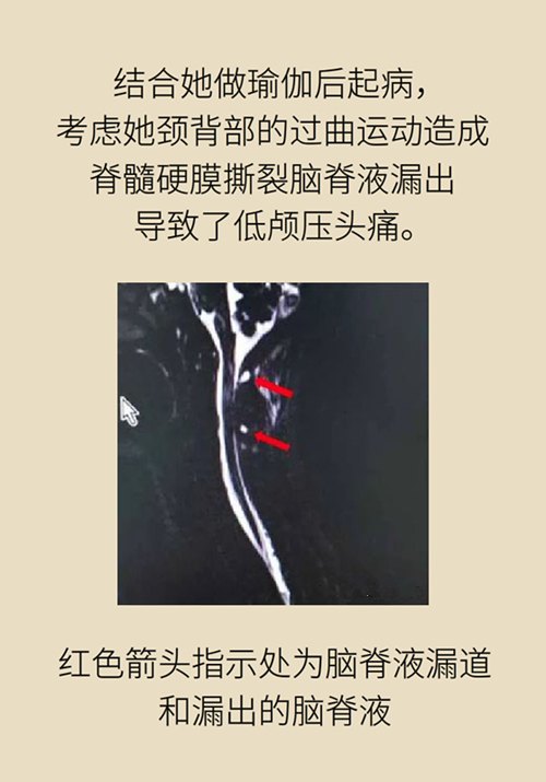 练瑜伽把脑脊液拉漏了！常见的“瑜伽病”你知道多少