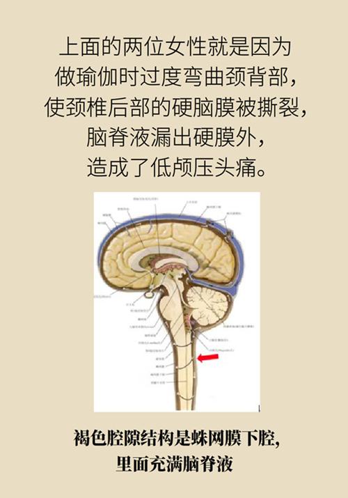练瑜伽把脑脊液拉漏了！常见的“瑜伽病”你知道多少