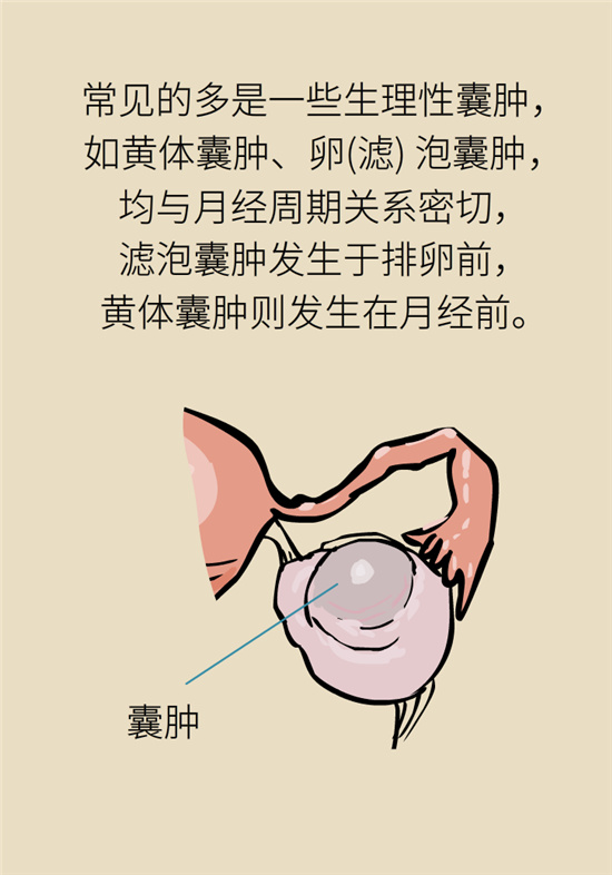 卵巢囊肿科普动漫：卵巢囊肿是肿瘤吗？要学会这样区分
