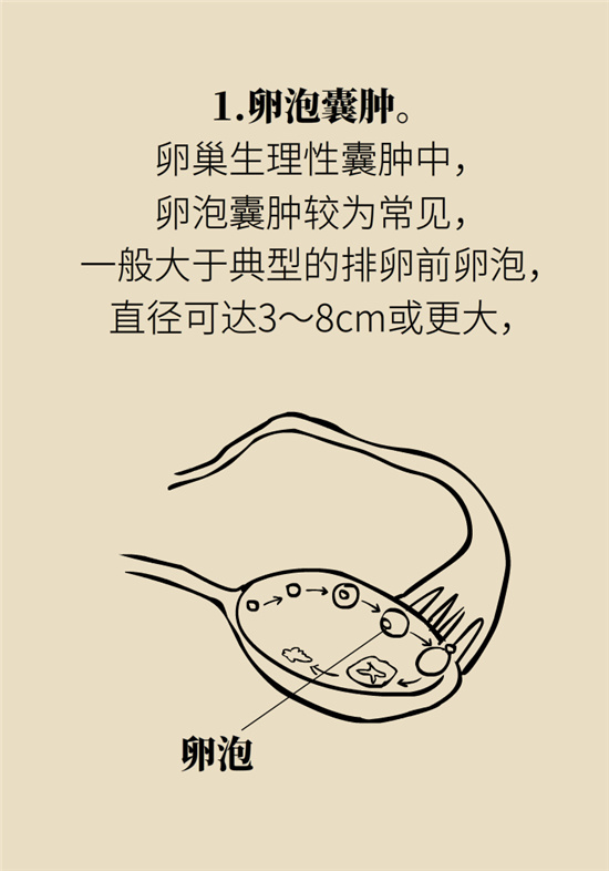 卵巢囊肿科普动漫：卵巢囊肿是肿瘤吗？要学会这样区分