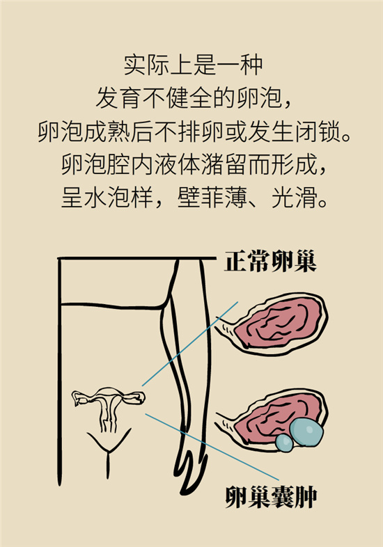 卵巢囊肿科普动漫：卵巢囊肿是肿瘤吗？要学会这样区分