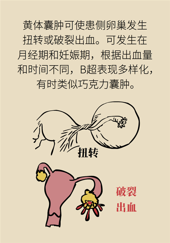 卵巢囊肿科普动漫：卵巢囊肿是肿瘤吗？要学会这样区分