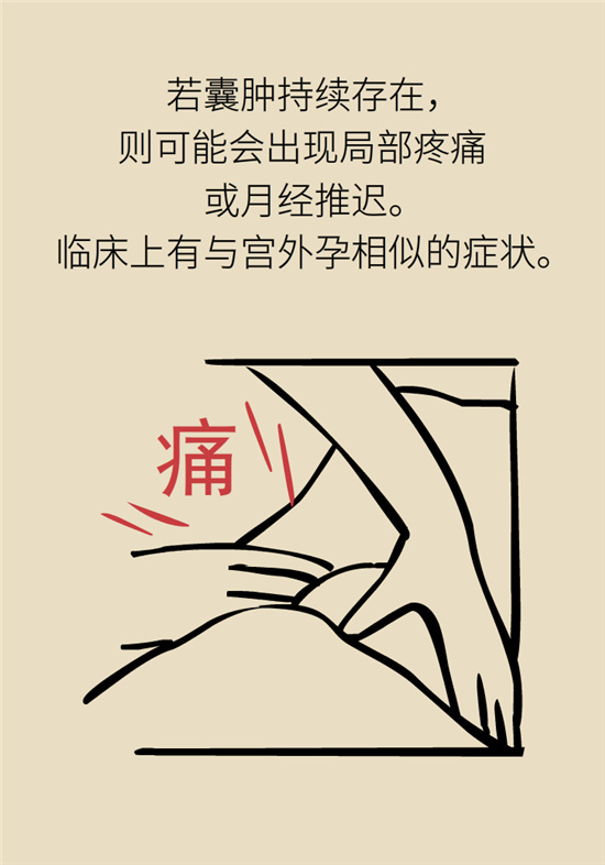 卵巢囊肿科普动漫：卵巢囊肿是肿瘤吗？要学会这样区分