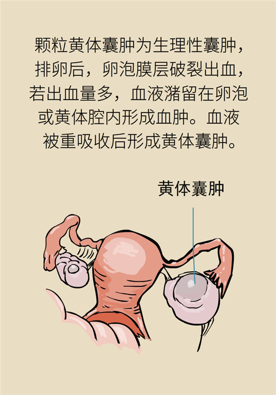 卵巢囊肿科普动漫：卵巢囊肿是肿瘤吗？要学会这样区分