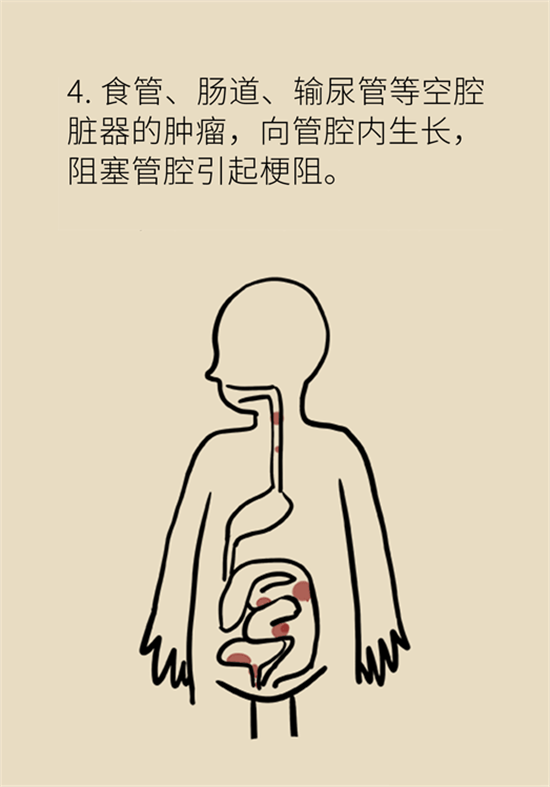 癌症到底有多痛？需要注意这7个重点问题
