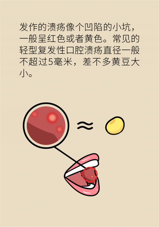 口腔溃疡还想约火锅？这四种情况一定要高度警惕