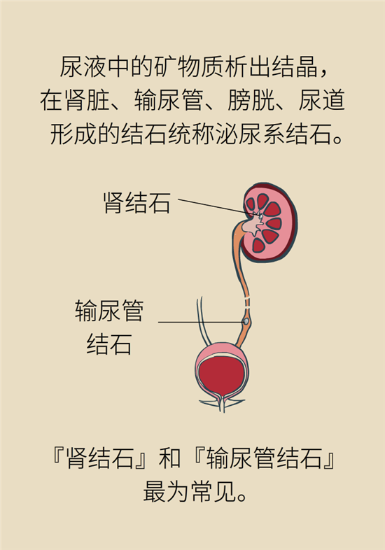 结石科普：身体里多了各种结石，应该怎么办？