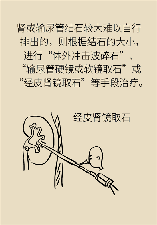 结石科普：身体里多了各种结石，应该怎么办？