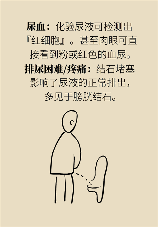 结石科普：身体里多了各种结石，应该怎么办？