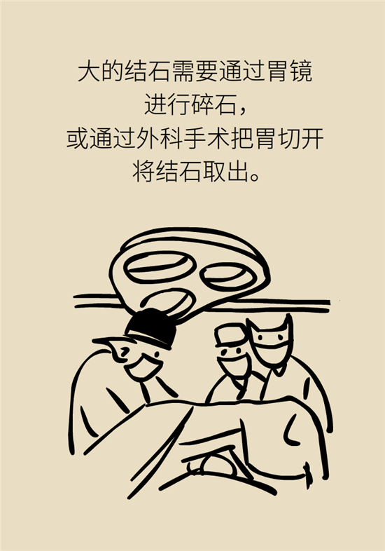 结石科普：身体里多了各种结石，应该怎么办？