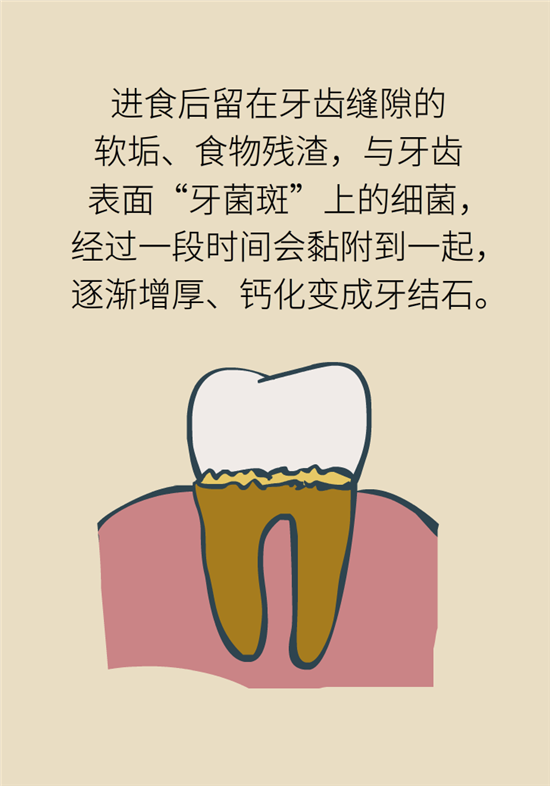 结石科普：身体里多了各种结石，应该怎么办？