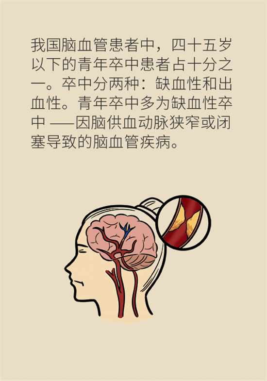 年纪轻轻别大意，小心脑卒中
