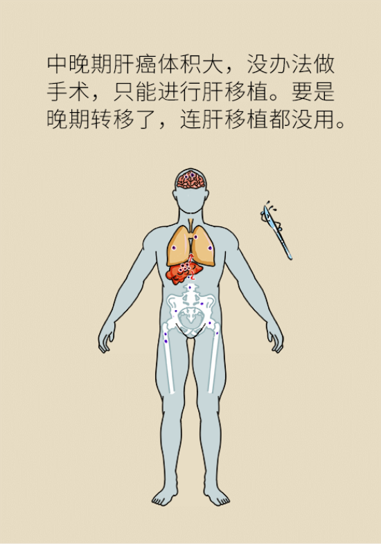 论发现早期肝癌的本事，cfDNA比AFP更精准，比影像学更早一步