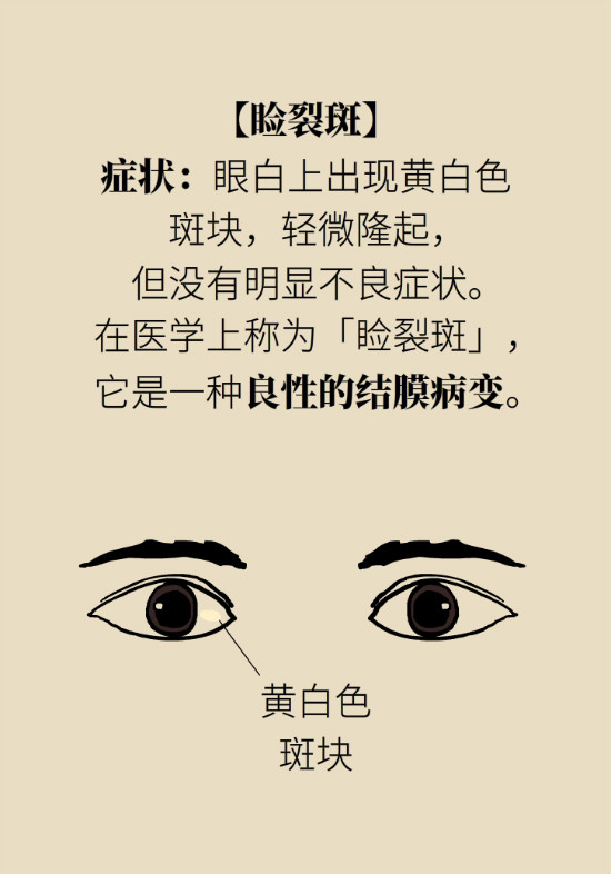 眼白有斑块、出血要紧吗?专家:名字唬人但问题不大 眼白有斑块、出血要紧吗?专家:名字唬人但问题不大