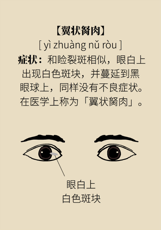 眼白有斑块、出血要紧吗?专家:名字唬人但问题不大 眼白有斑块、出血要紧吗?专家:名字唬人但问题不大
