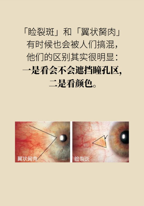 眼白有斑块、出血要紧吗?专家:名字唬人但问题不大 眼白有斑块、出血要紧吗?专家:名字唬人但问题不大