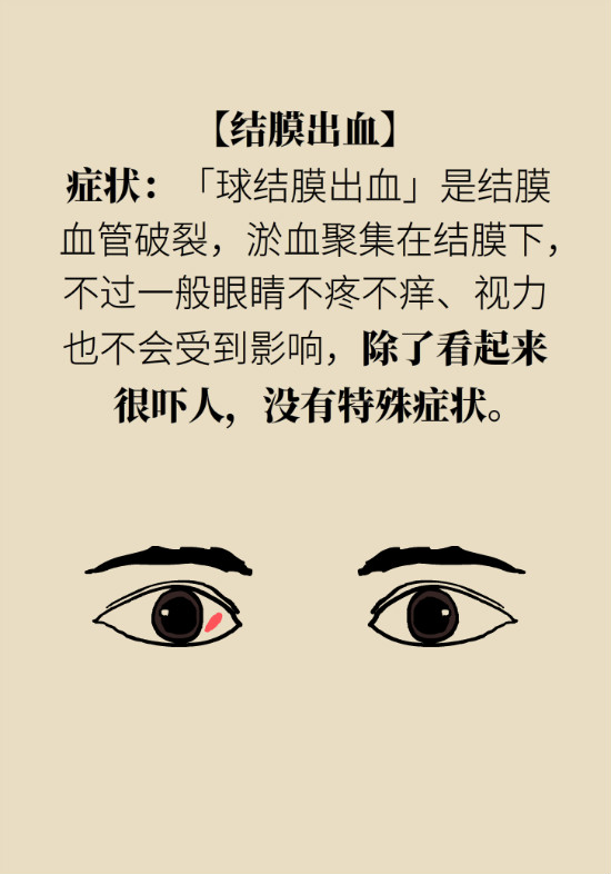 眼白有斑块、出血要紧吗?专家:名字唬人但问题不大 眼白有斑块、出血要紧吗?专家:名字唬人但问题不大