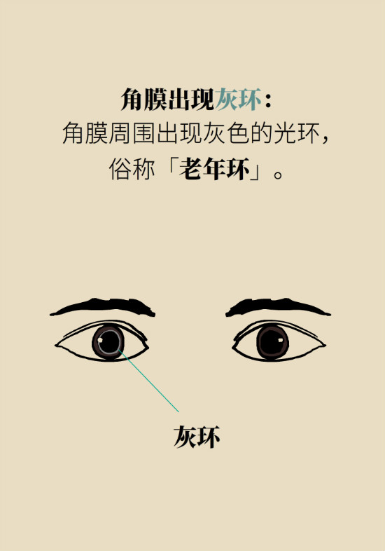 眼白有斑块、出血要紧吗?专家:名字唬人但问题不大 眼白有斑块、出血要紧吗?专家:名字唬人但问题不大