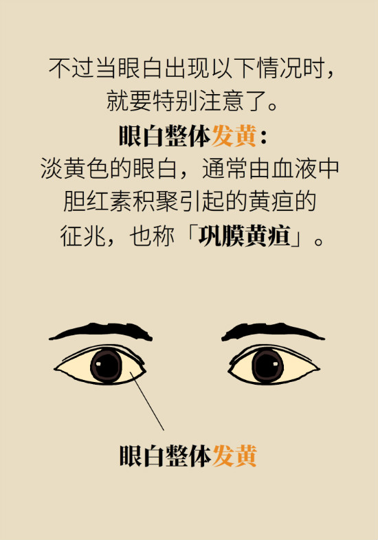 眼白有斑块、出血要紧吗?专家:名字唬人但问题不大 眼白有斑块、出血要紧吗?专家:名字唬人但问题不大