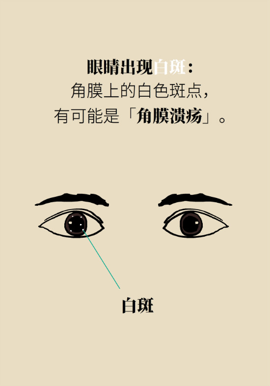 眼白有斑块、出血要紧吗?专家:名字唬人但问题不大 眼白有斑块、出血要紧吗?专家:名字唬人但问题不大