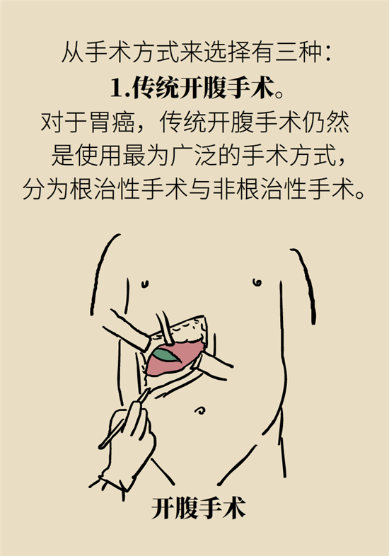 胃癌手术一定要全切胃？专家：视情况而定