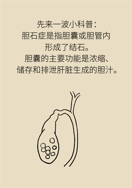胆结石主要成分竟是胆固醇？预防它只需四个字