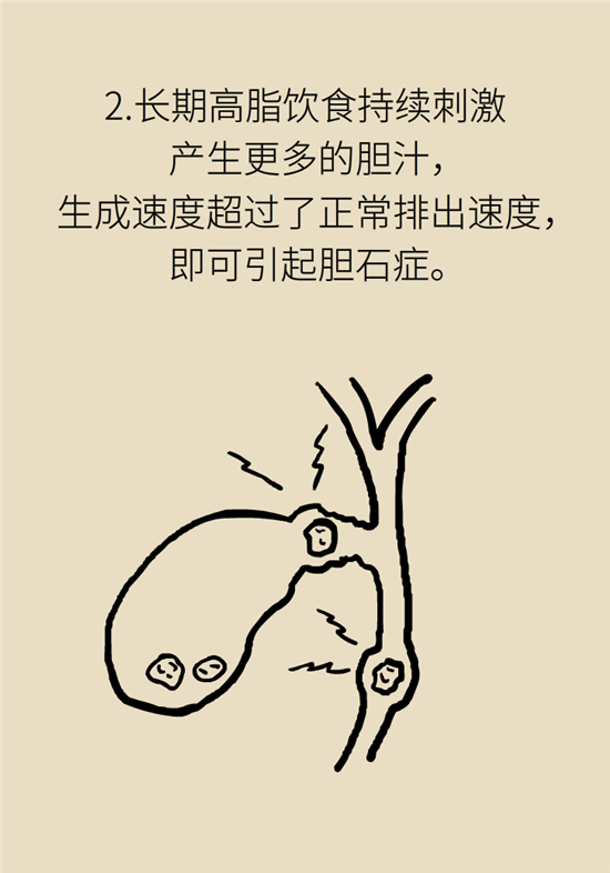 胆结石主要成分竟是胆固醇？预防它只需四个字