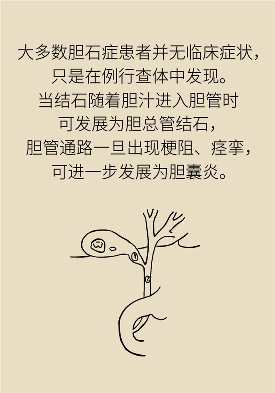 胆结石主要成分竟是胆固醇？预防它只需四个字