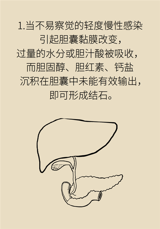 胆结石主要成分竟是胆固醇？预防它只需四个字