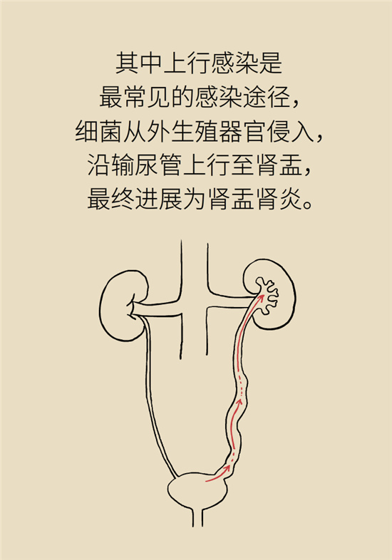 经常憋尿会得急性肾炎？