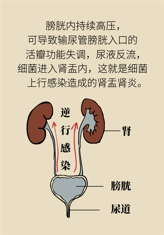经常憋尿会得急性肾炎？