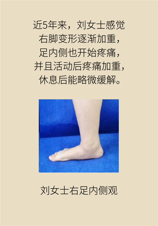 走几百米路就疼得不行了?可能患上了平足症 走几百米路就疼得不行了?可能患上了平足症
