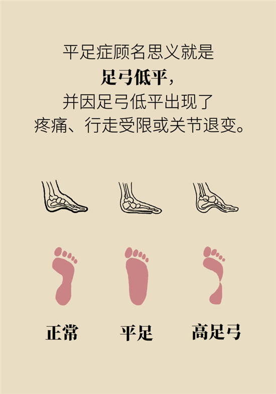 走几百米路就疼得不行了?可能患上了平足症 走几百米路就疼得不行了?可能患上了平足症