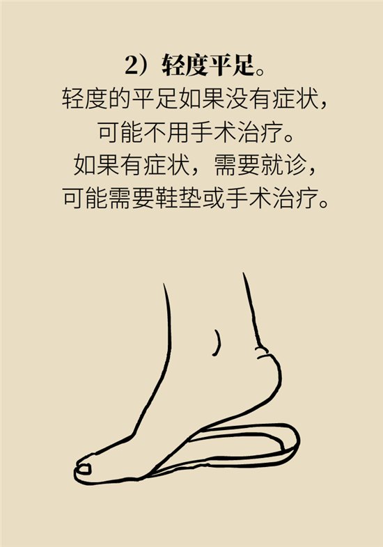 走几百米路就疼得不行了?可能患上了平足症 走几百米路就疼得不行了?可能患上了平足症