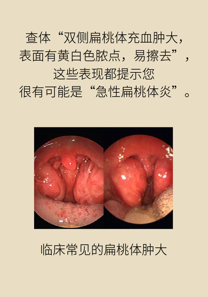单侧扁桃体肿大更凶险！谨防恶性肿瘤