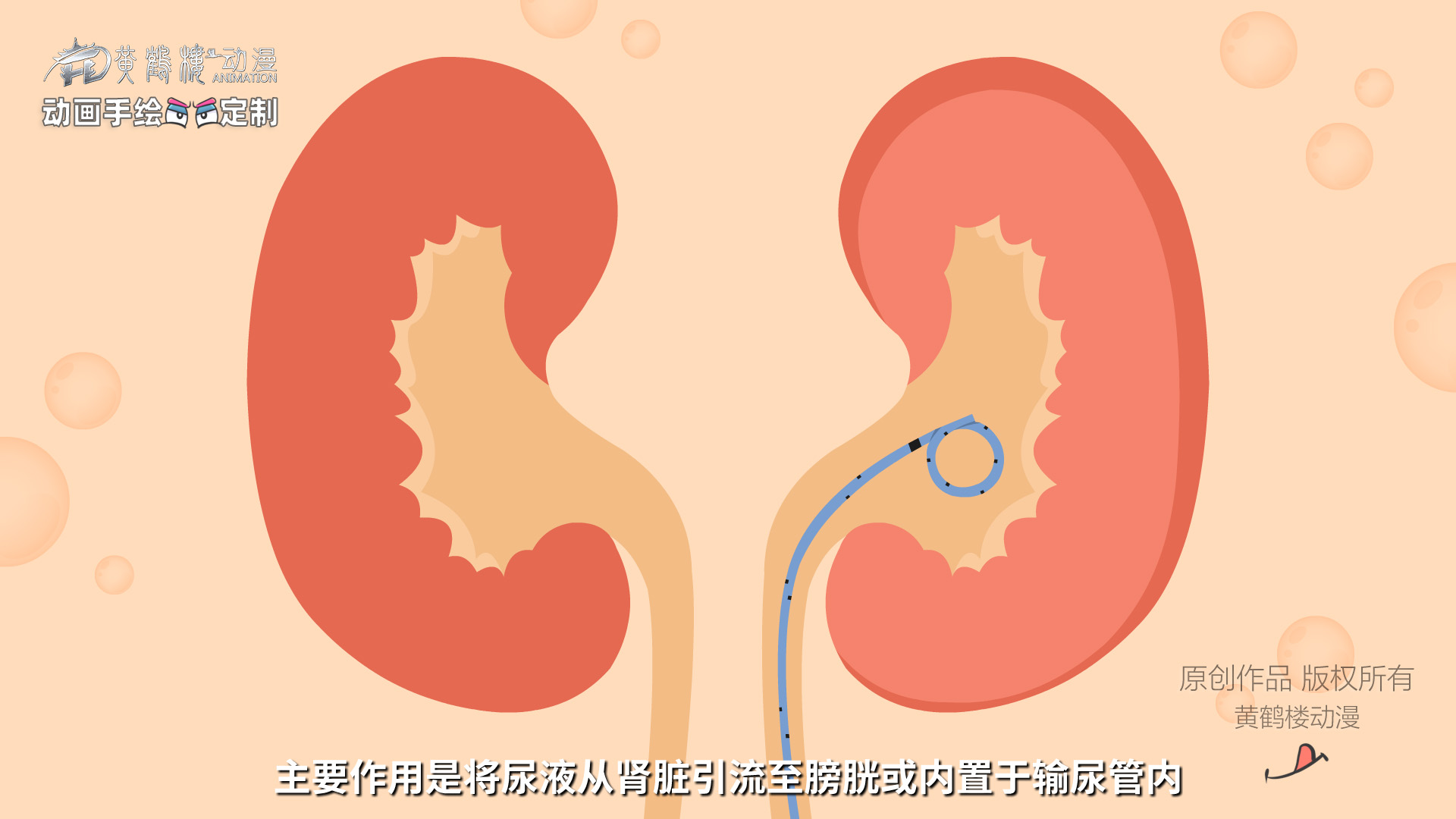 输尿管支架科普0002.jpg