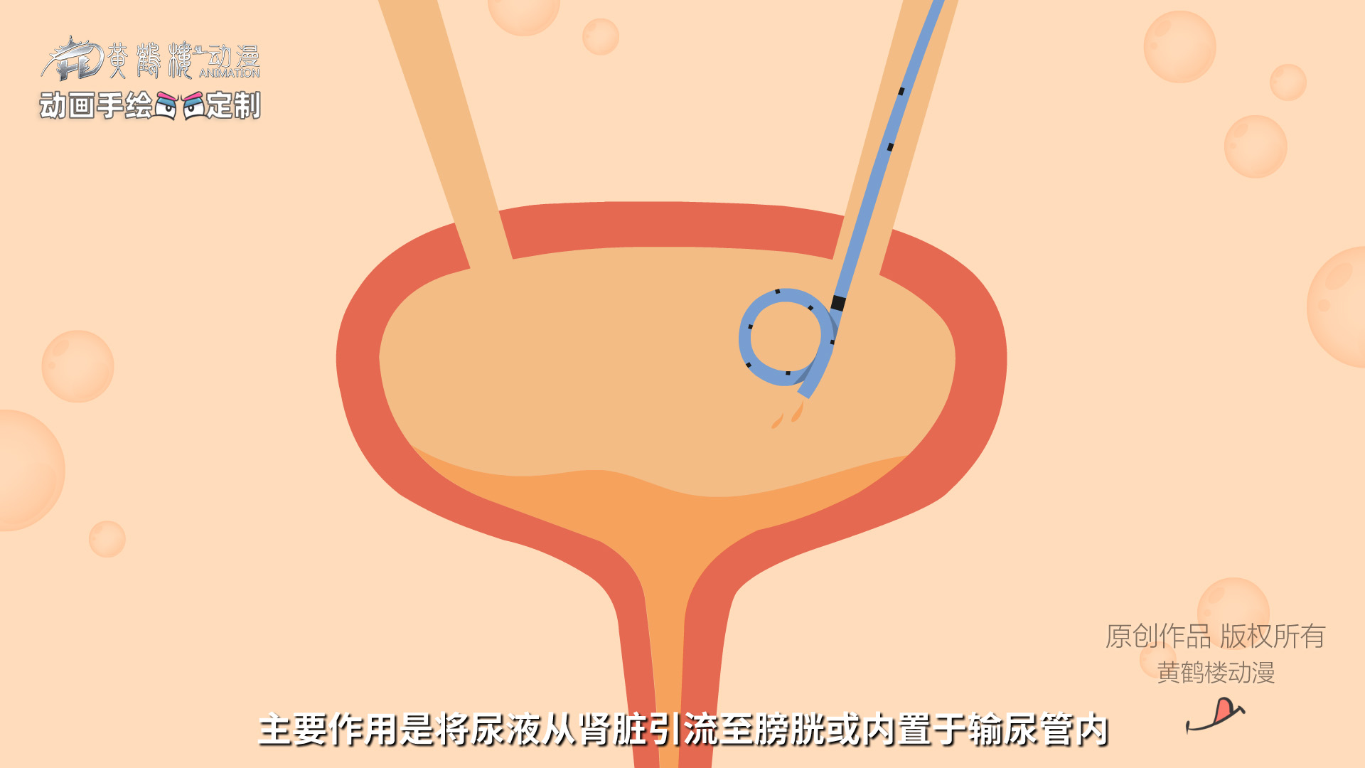 输尿管支架科普0003.jpg