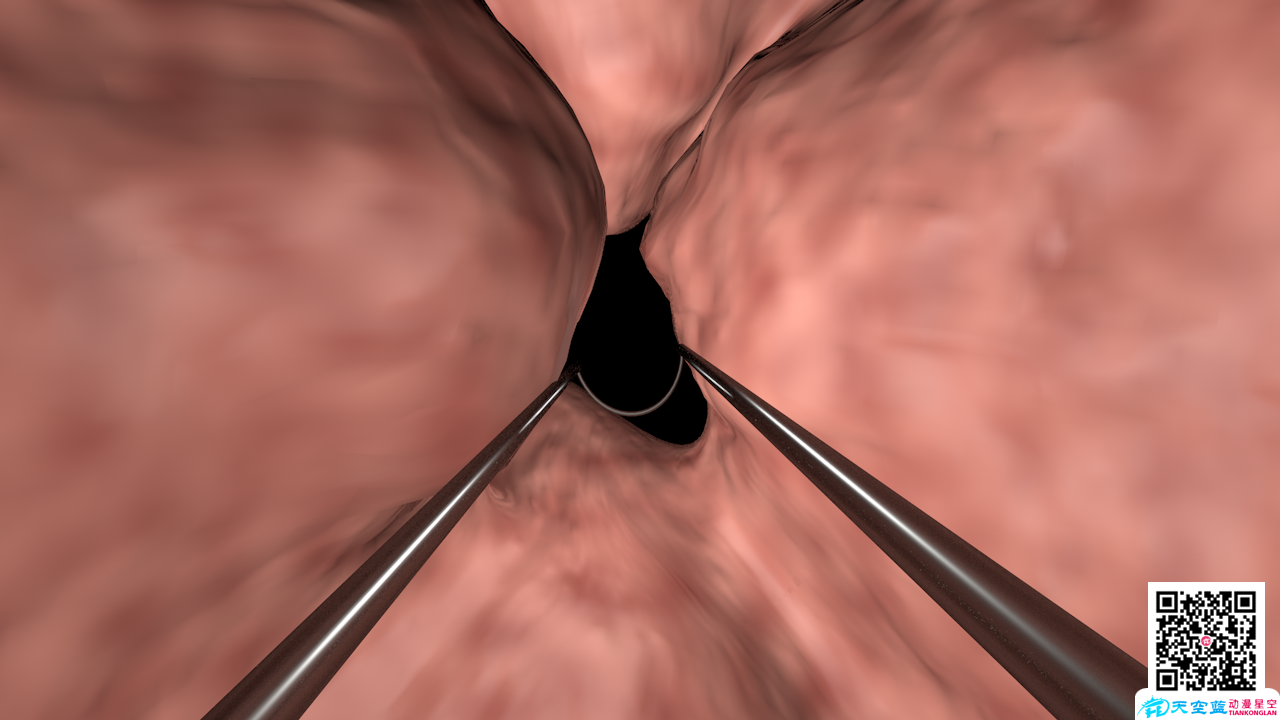 《微創經尿道前列腺等離子雙極電切術》三維醫療手術演示動畫視頻