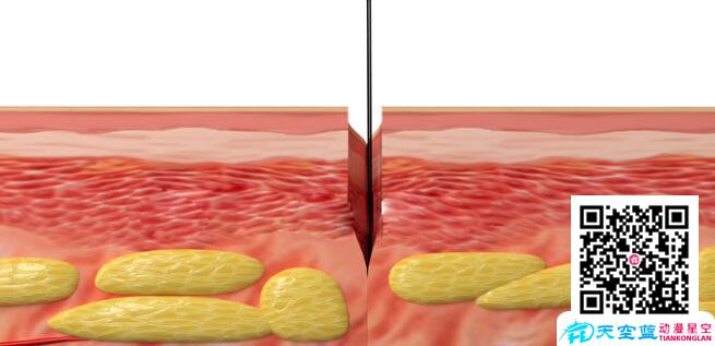 皮肤穿刺医学动画.jpg